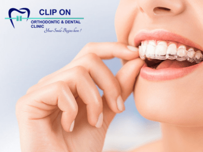 Invisalign treatment in Pallavaram