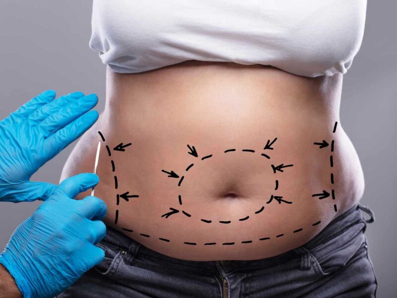 Recovery After Liposuction: Insights and Support from De Aesthetikos